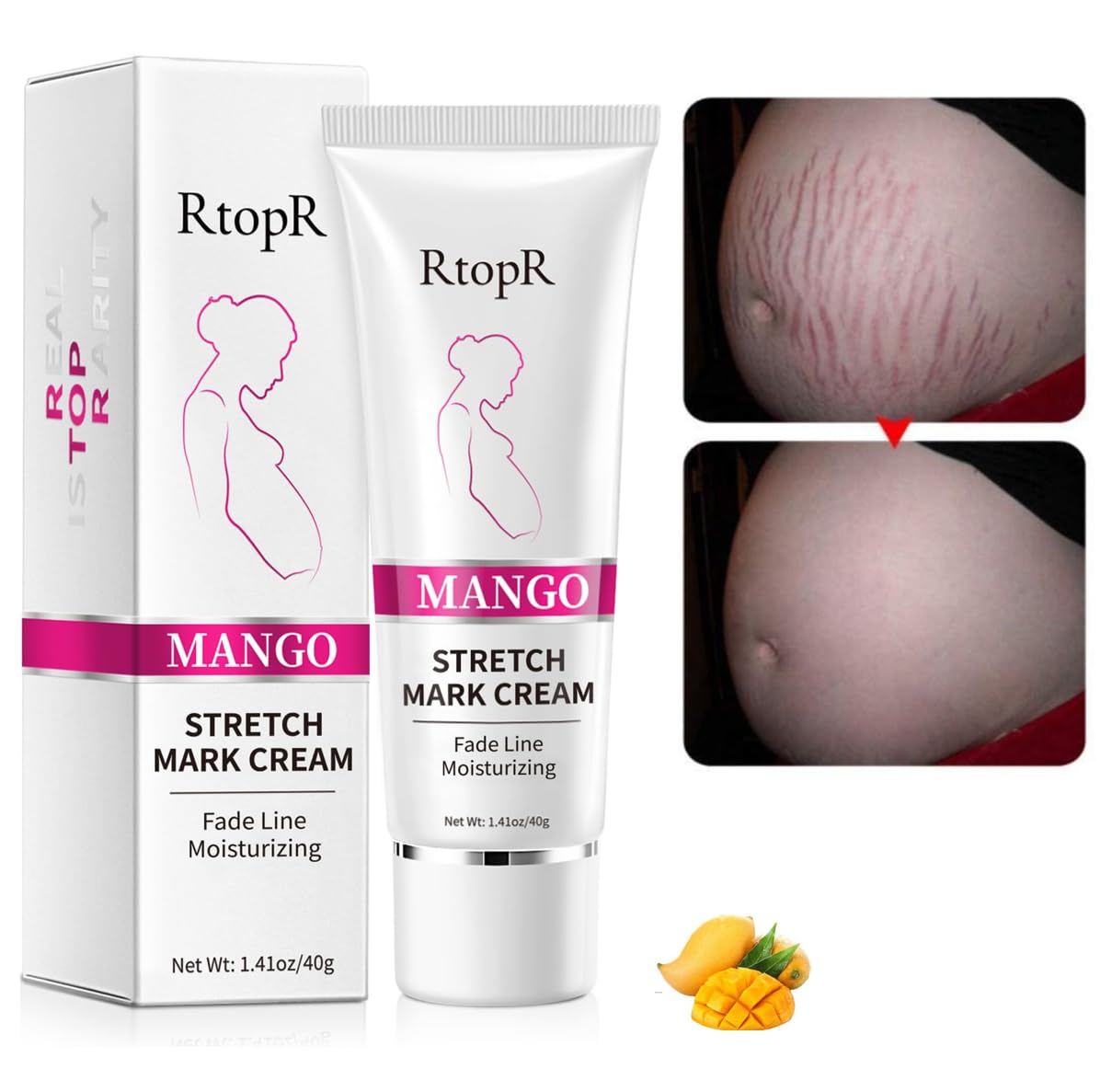 Stretch Mark Removal Cream, Obesity Stretch Mark Moisturizer, Postpartum Repair Stretch Mark Cream, Abdominal Stretch Mark Cream, Remove Marks (1 PCS)