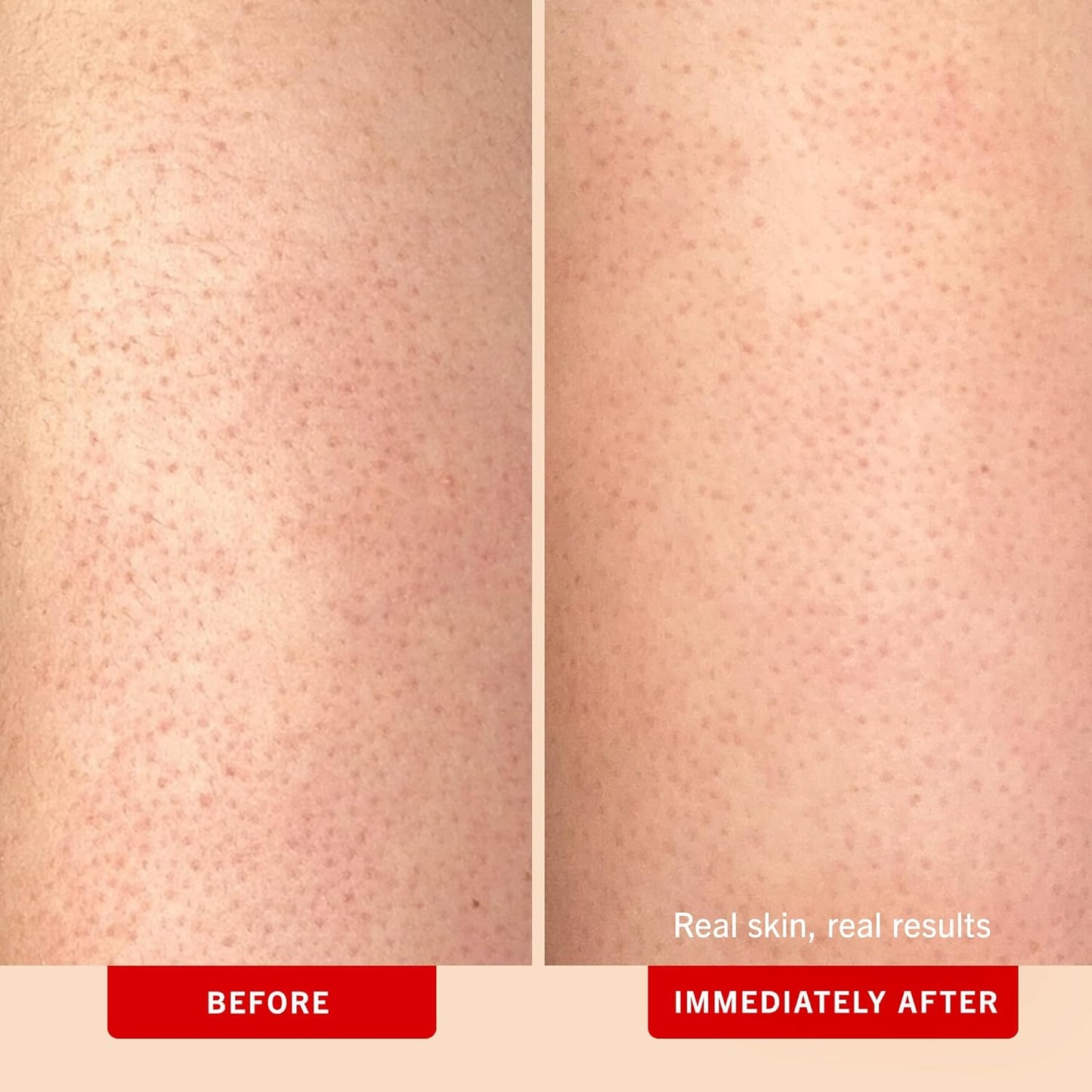 First Aid Beauty - KP Bump Eraser Body Scrub with 10% AHA, Keratosis Pilaris Exfoliator with Glycolic and Lactic acids, Helps Reduce Chicken Skin Bumps, Safe for Sensitive Skin, Peach Scent (2 oz)