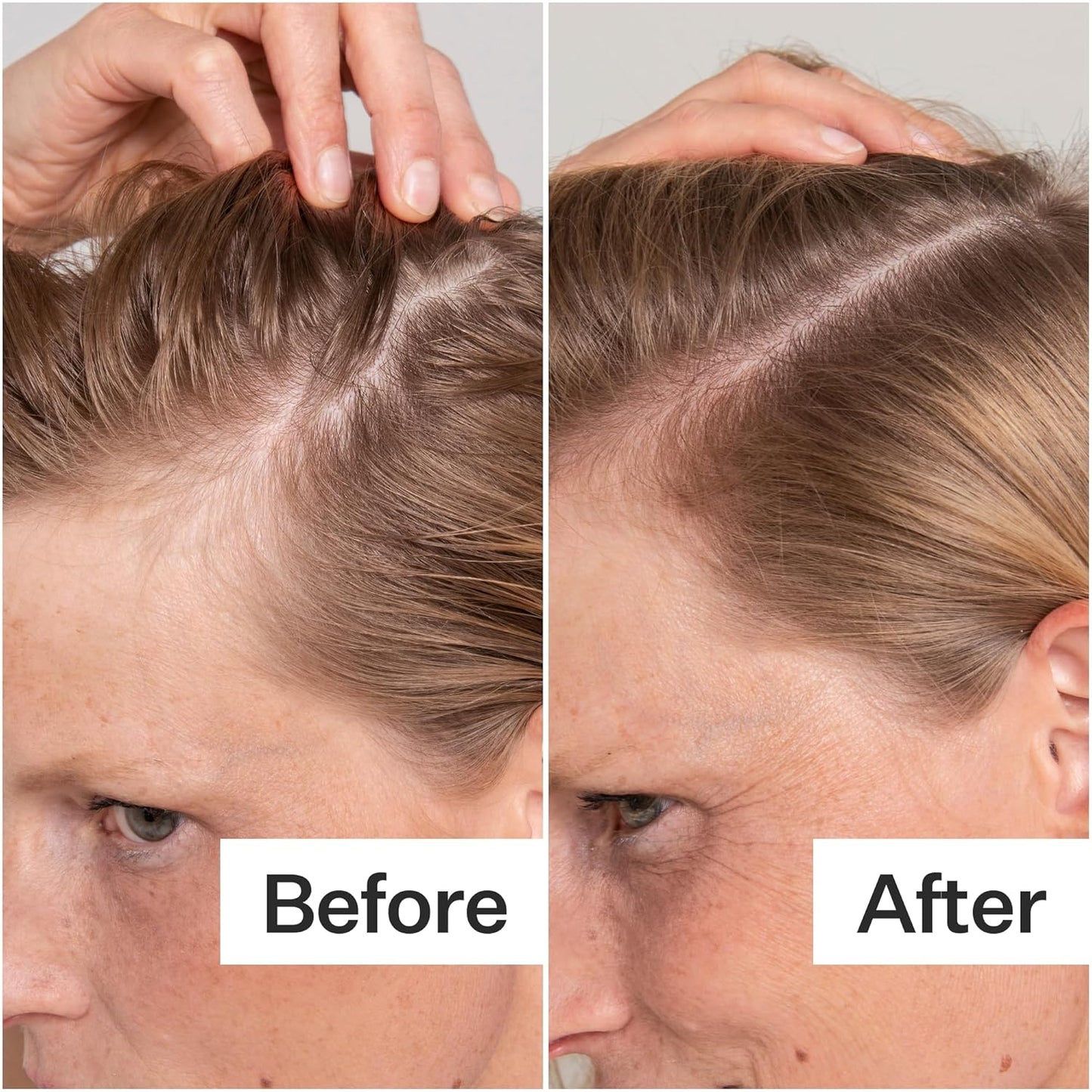 ACT+ ACRE Cold Processed Salicylic Acid Exfoliator | For Loose Flakes, Excess Oil, Scalp Build-Up | Salicylic Acid, Papaya, Peppermint | Balance, Soothe | Vegan, Color Safe, Fragrance-Free | 2 Fl Oz